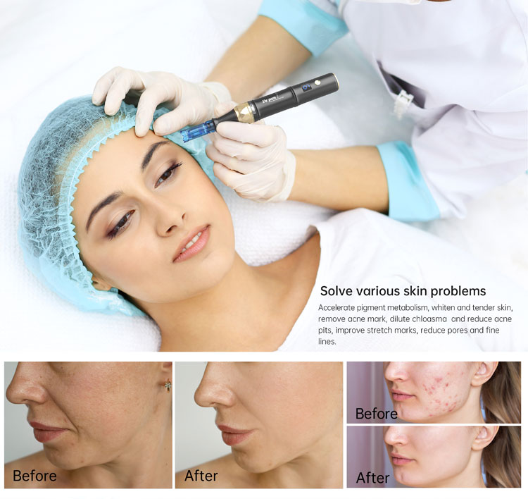 skin pen microneedling cost