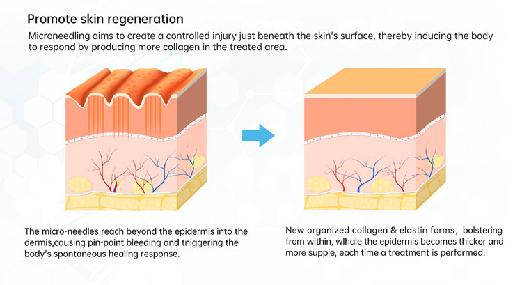 skinpen microneedling