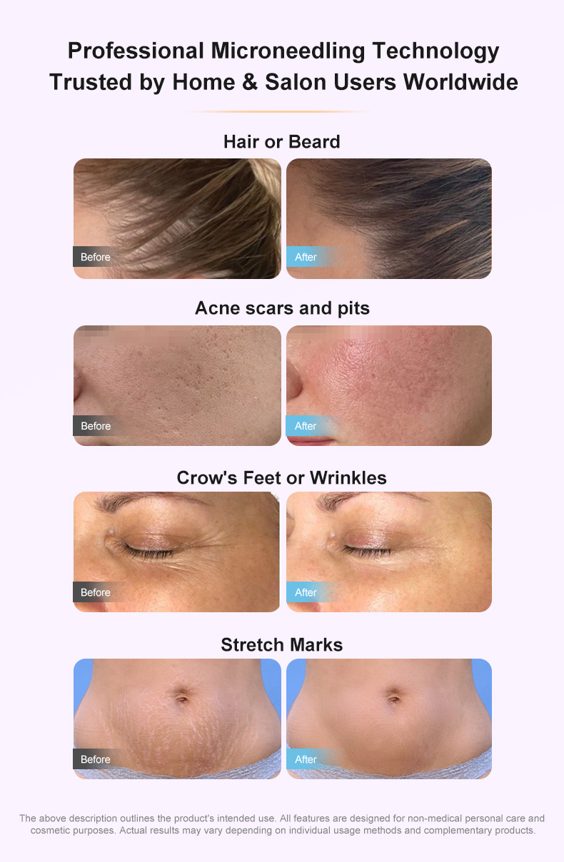 adjustable derma pen