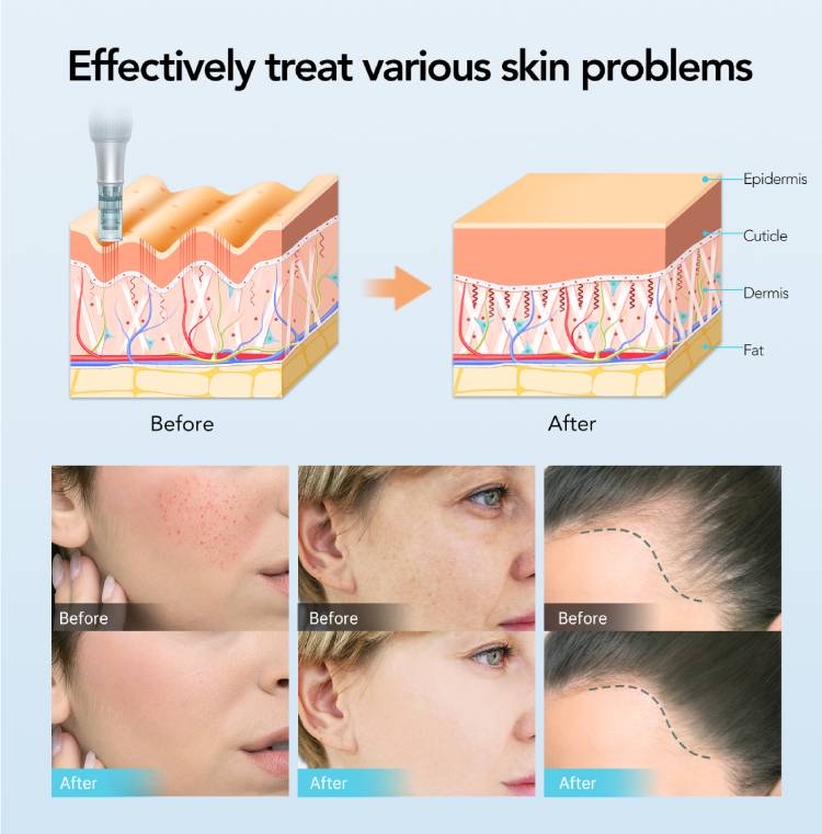 derma pen before and after