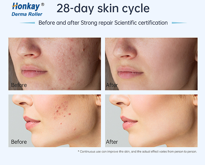 20 Pin Derma Stamp