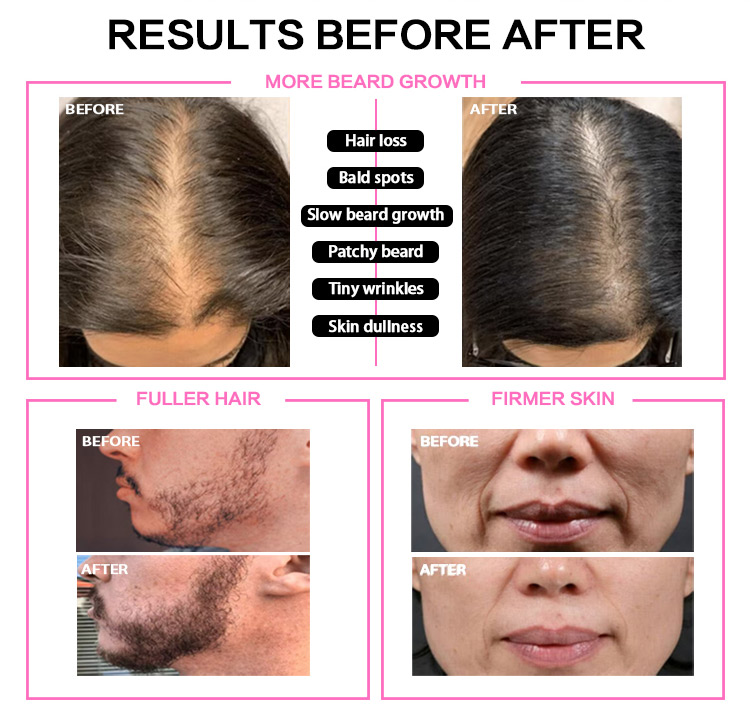 gold needle derma stamp
